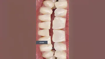 [ES] ¡Pruebe ahora y aproveche la alta estética con Vittra APS Unique!💛